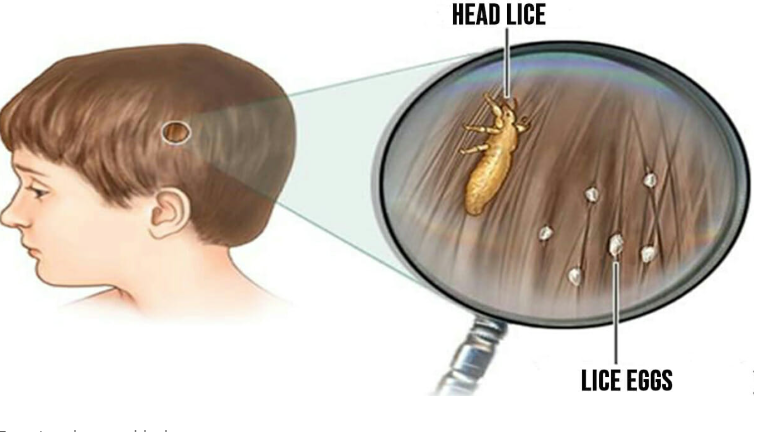 Head lice: How to get rid of them and stop them coming back